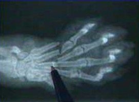 Gin trap x-ray on cat's paw